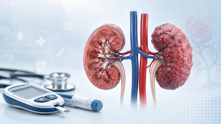 Hypertension, Diabetes Raise Kidney Failure Risk – Expert